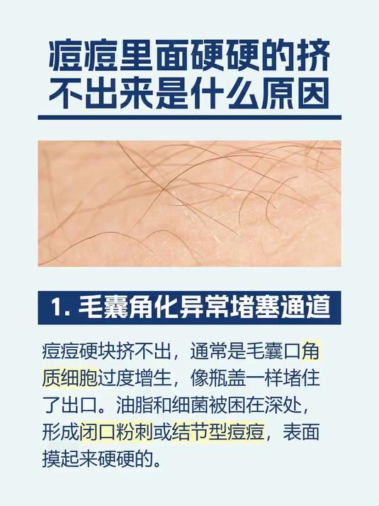 痘痘里面硬硬的挤不出来是什么原因