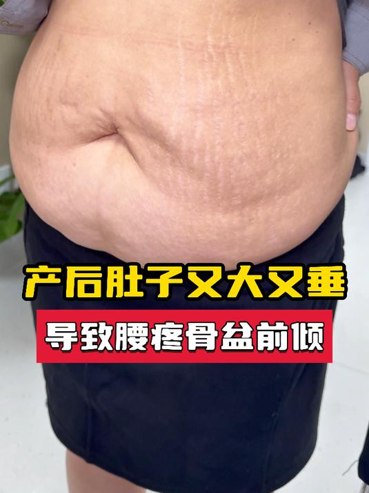 宝妈肚子大又松又有妊娠纹，腹壁全面肌肉增强，腰型也能塑造！
