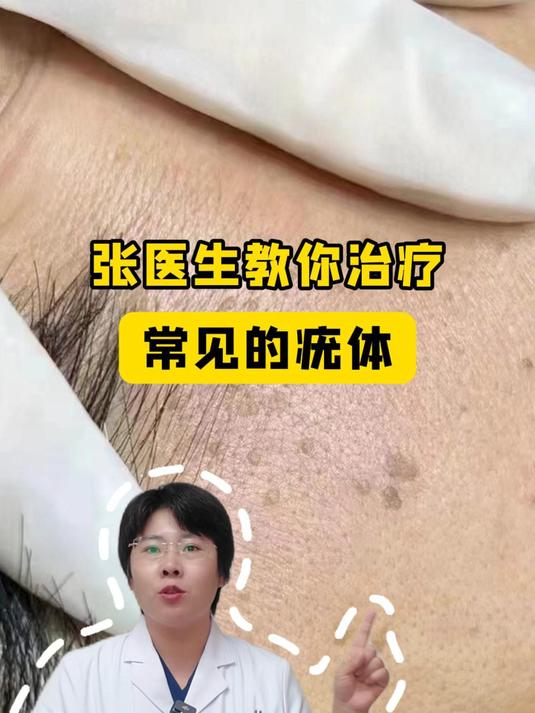 张医生教你治疗常见的疣体