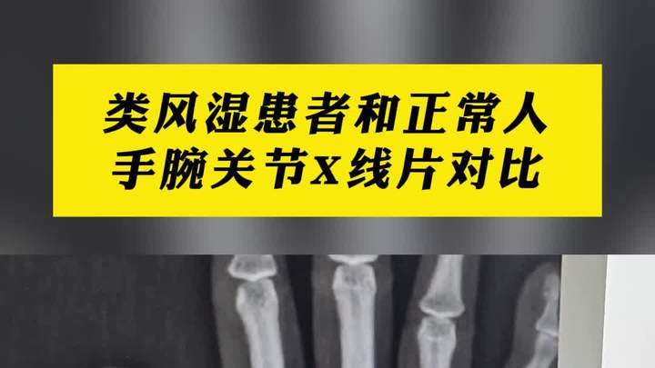 类风湿患者和正常人手腕关节对比