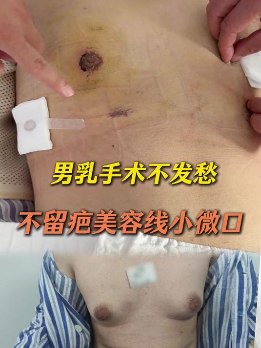 男乳手术不发愁不留疤美容线小微口