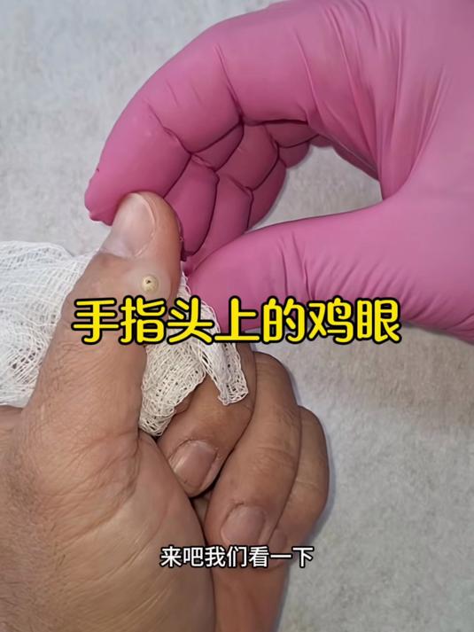 手指头上的鸡眼