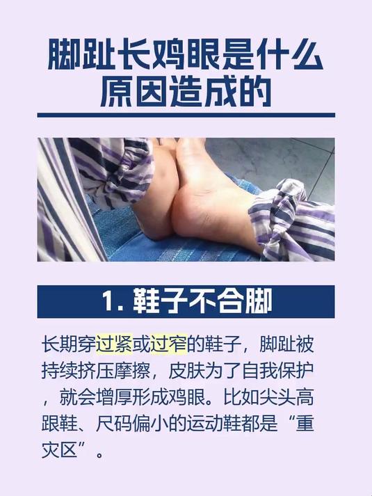 脚趾长鸡眼是什么原因造成的