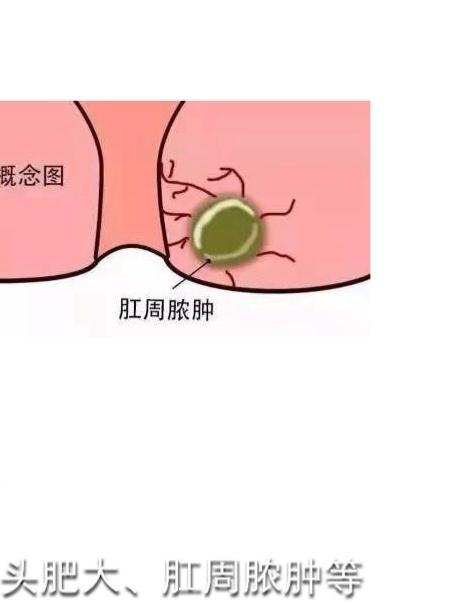 菊部的“小肉球”原因繁多,弄清病因才能对症治疗!