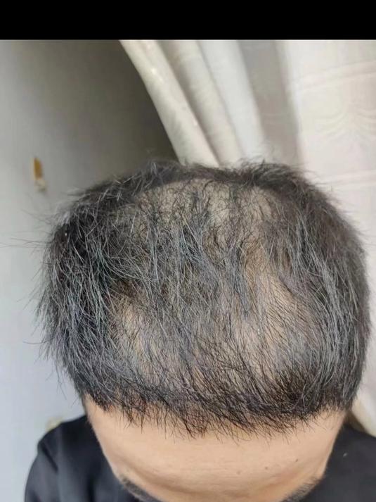 中年男性生发:告别地中海