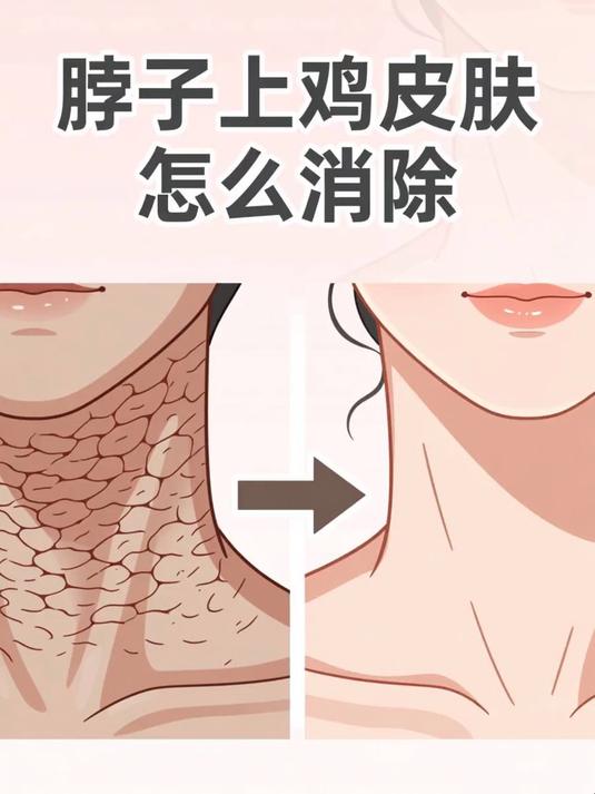 脖子上鸡皮肤怎么消除