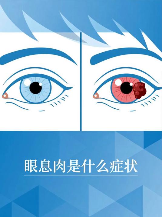 眼息肉是什么症状