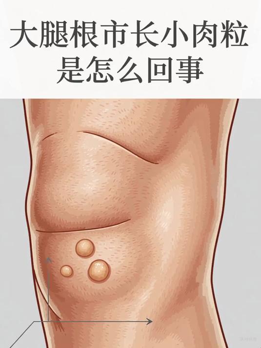 大腿根部长小肉粒是怎么回事 #健康扬帆季#
