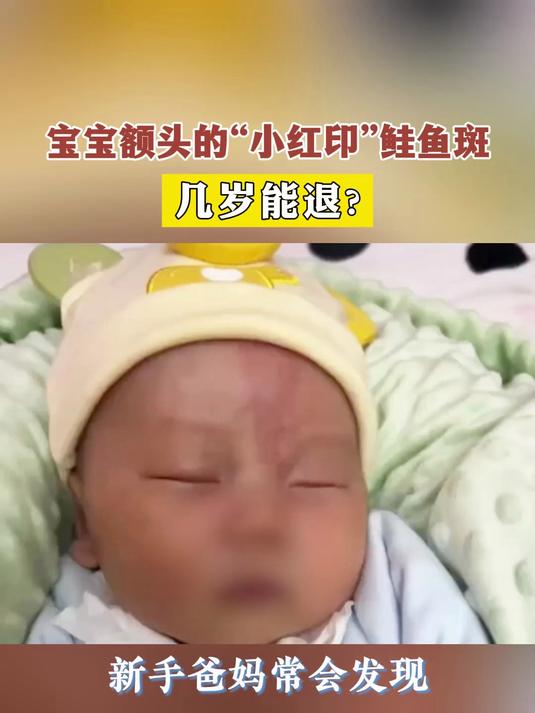 宝宝额头的“小红印”鲑鱼斑,几岁能退?