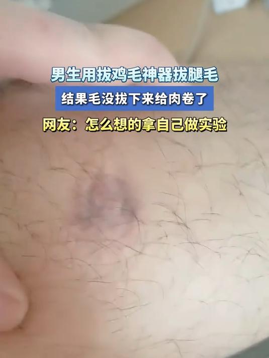 男生用拔鸡毛神器拔腿毛,结果毛没拔下来给肉卷了
