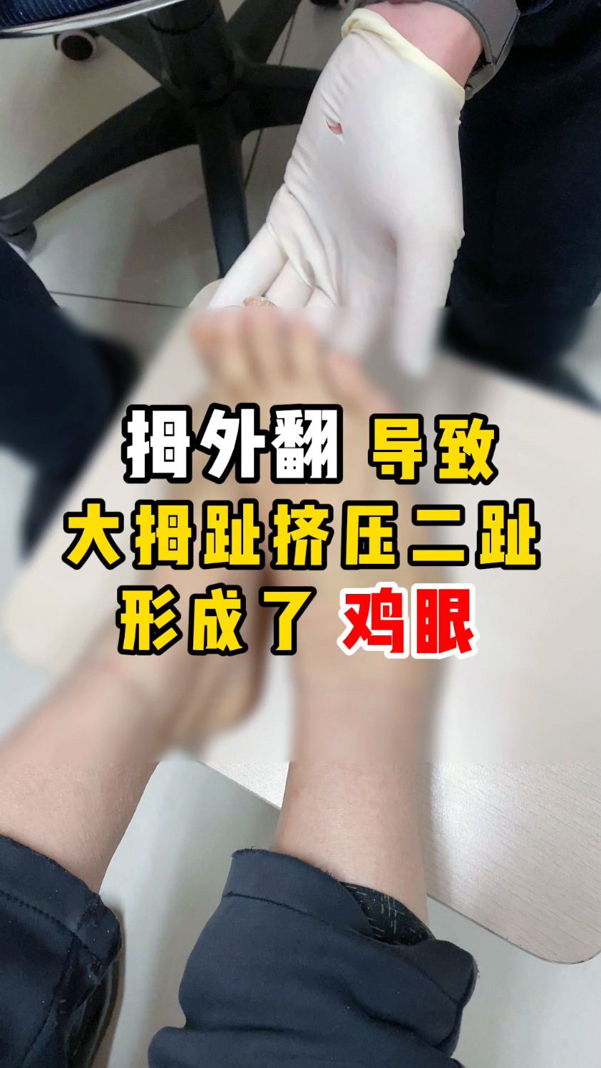 拇外翻/大脚骨导致大拇趾挤压二趾,形成了鸡眼