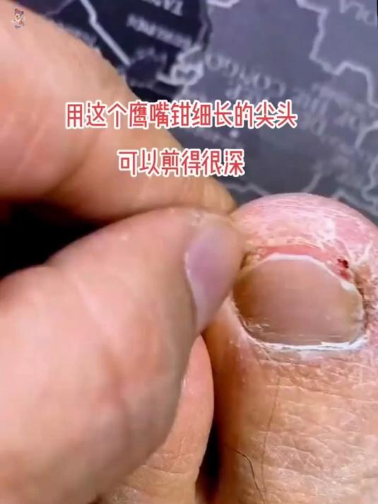 指甲长肉里怎么办?用用这款鹰嘴钳,3 秒修剪断,不伤指甲!