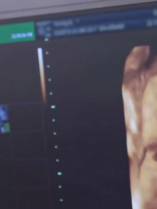 肾输尿管膀胱彩超主要检查什么