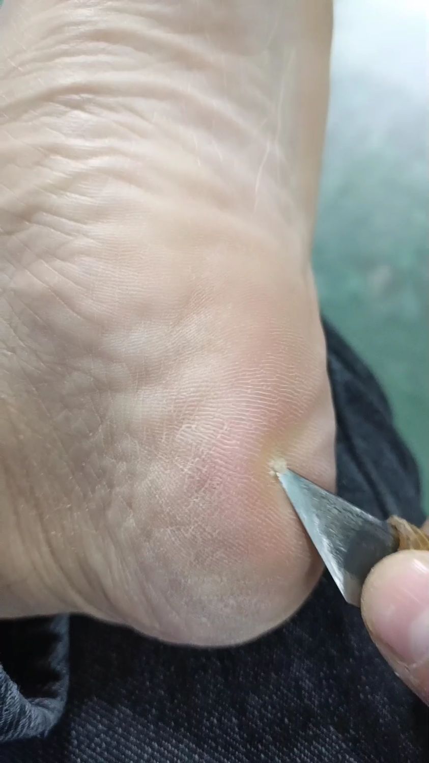 脚后跟有“鸡眼”的朋友们注意了,请点赞关注和收藏。千万不要去医院做手术因为会复发