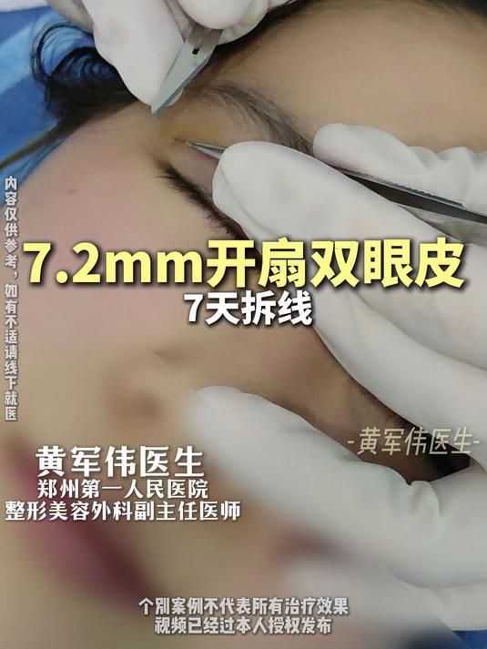 7.2mm开扇双眼皮,术后7天拆线!