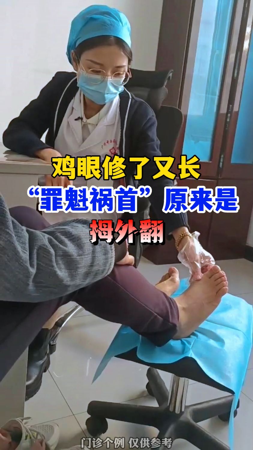 拇外翻导致鸡眼修了又长