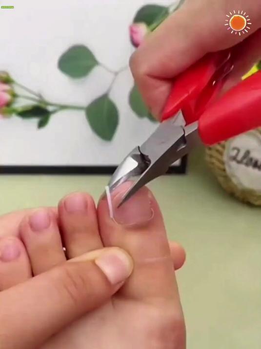 嵌甲分离片，指甲不再向肉长，像隔棉花般特别舒服！