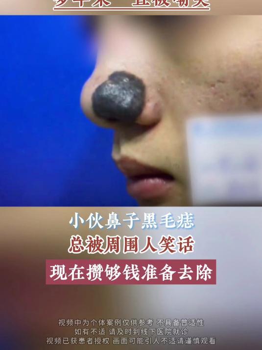 小伙鼻子长大黑包,看着像被蚂蟥吸住,多年来一直被嘲笑