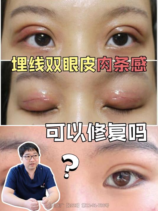 埋线双眼皮肉条感可以修复吗