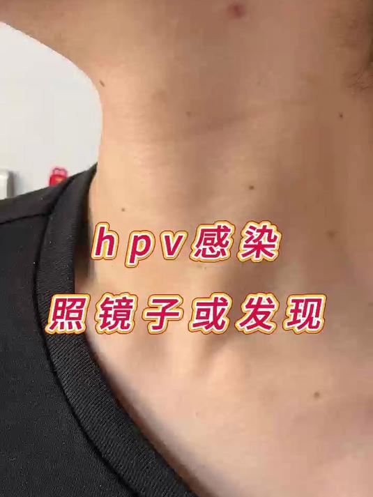 HPV感染,照镜子或发现