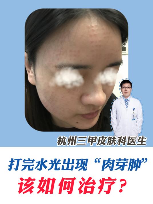 水光针打完出现“肉芽肿”如何治疗?如何避免?