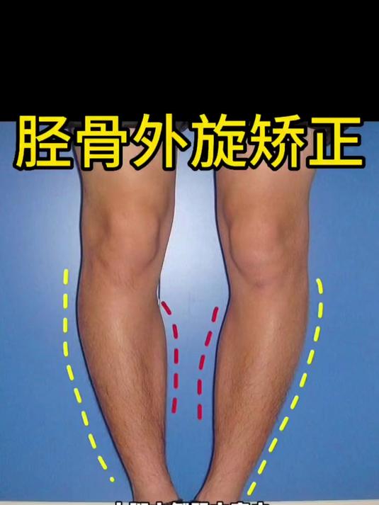小腿肌肉外翻可以说是 99%的女生都会存在的问题