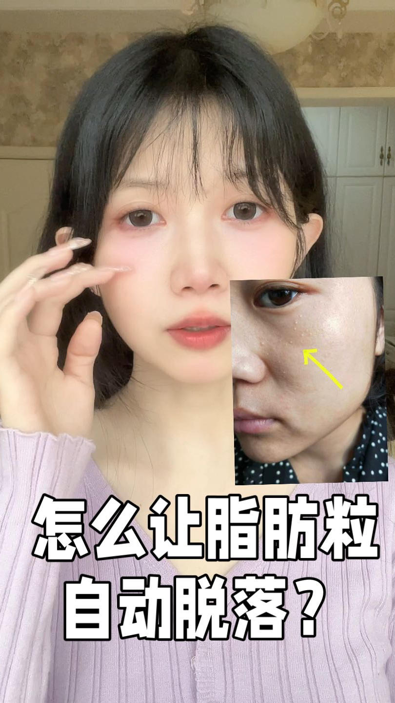 怎么让脂肪粒自动脱落?