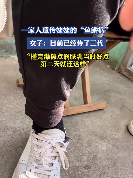 一家人遗传姥姥的“鱼鳞病”，女子：目前已经传了三代，搓完澡擦点润肤乳当时好点第二天就还这样