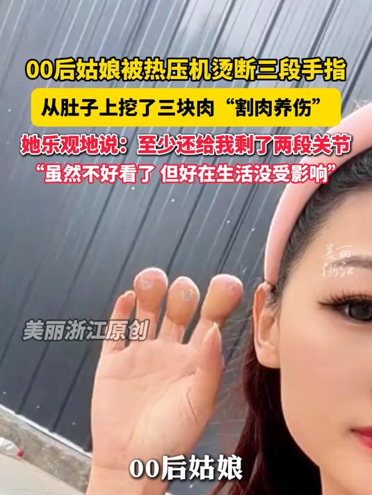 被热压机烫断三段手指 00后姑娘从肚子上挖了三块肉“割肉养伤” 她乐观地说:至少还给我剩了