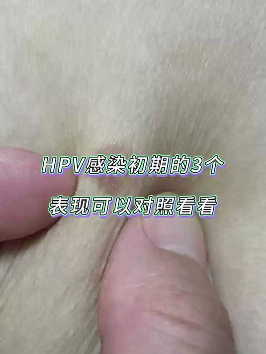 HPV感染初期的3个表现,可以对照看看