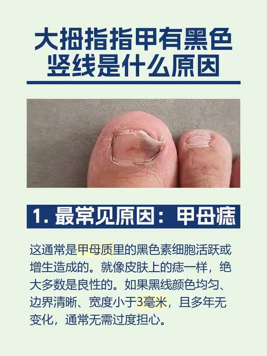 #马上健康过大年#大拇指指甲有黑色竖线是什么原因