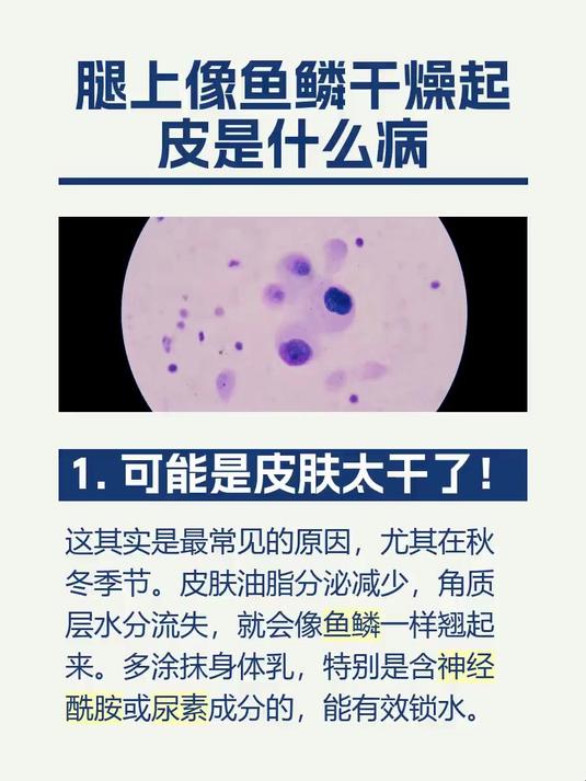 #马上健康过大年#腿上像鱼鳞干燥起皮是什么病
