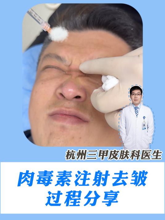 皮肤科博士|全脸肉毒素去皱提升 看看效果吧!