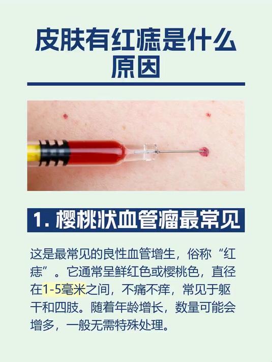 皮肤有红痣是什么原因