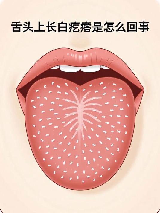 舌头上长白疙瘩是怎么回事 #健康扬帆季#