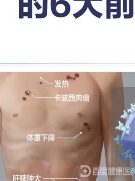 男人艾滋6个前兆，你知道吗