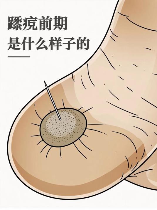 跖疣前期是什么样子的
