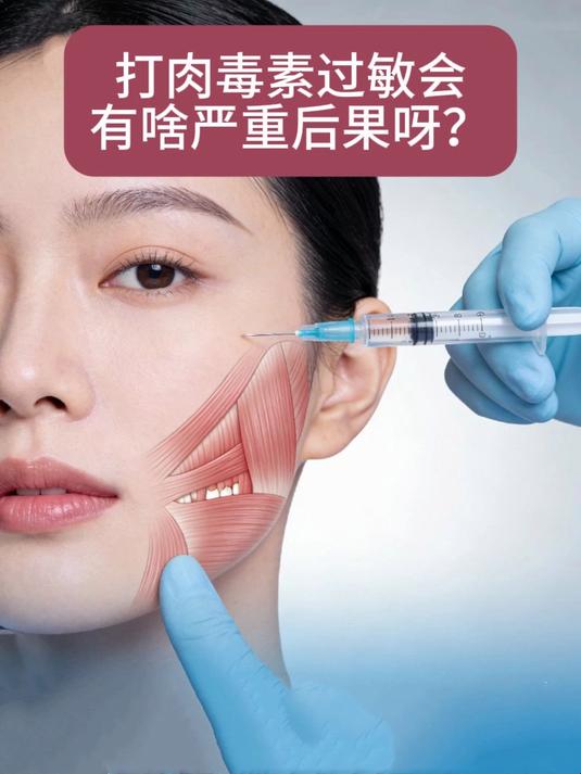 #健康扬帆季#打肉毒素过敏会有啥严重后果呀?