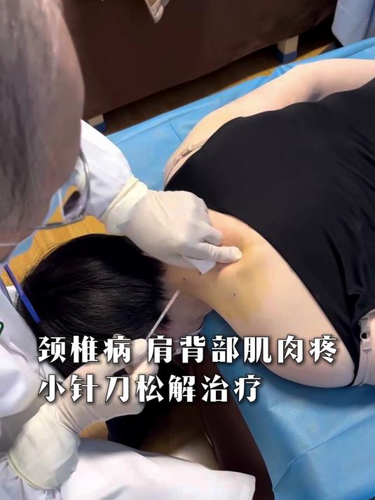 颈椎病 肩背部肌肉疼 小针刀松解治疗