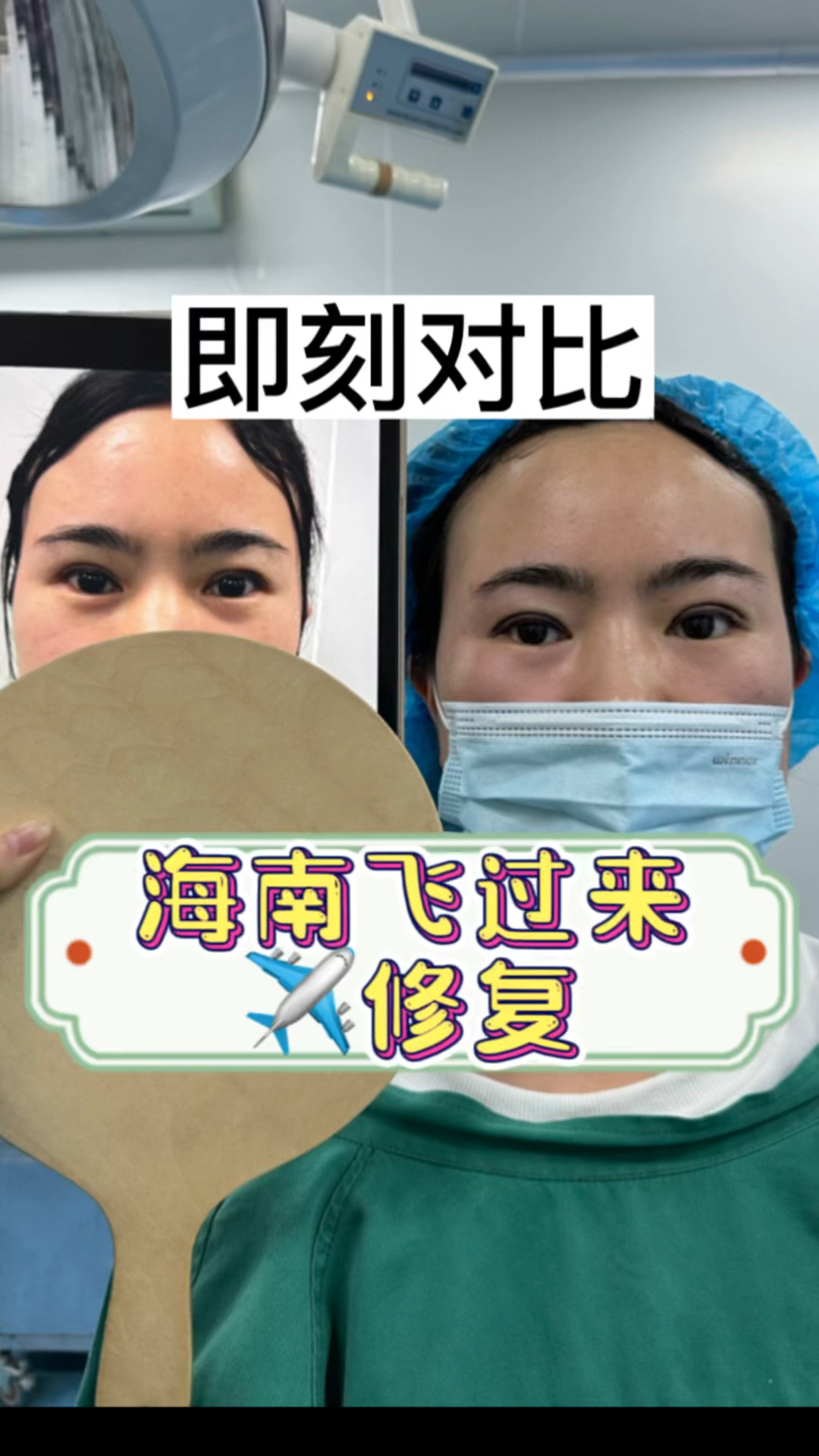 #双眼皮修复 肉条改善 即刻对比