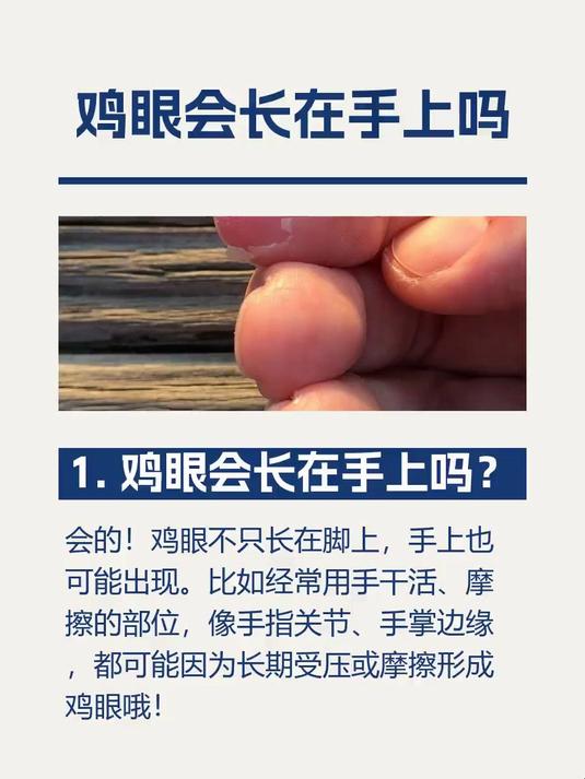 鸡眼会长在手上吗