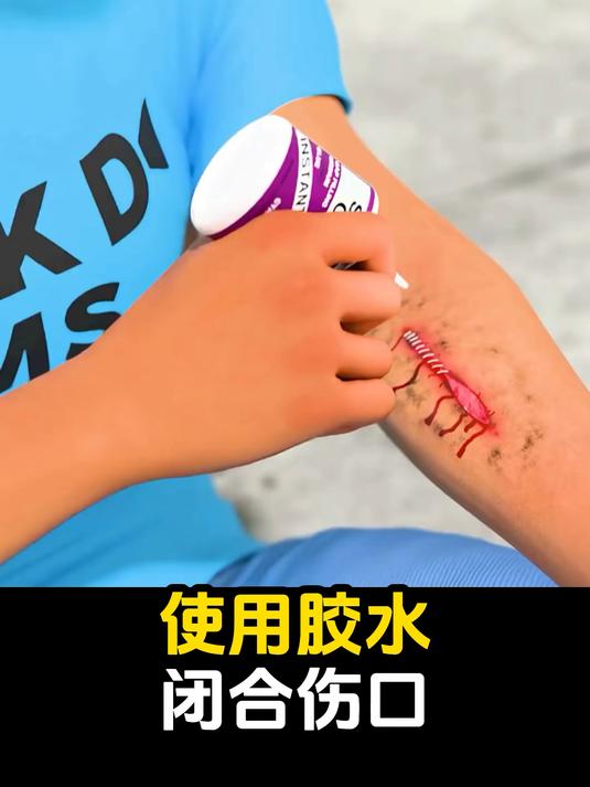 #知识科普#使用胶水闭合伤口
