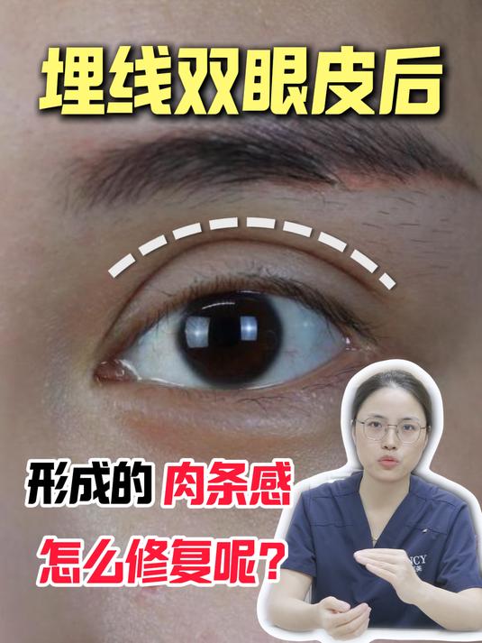 埋线双眼皮后形成的肉条感怎么修复呢?