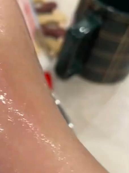 被烫熟了 网友：没想到这辈子还能见到人肉熟了的样子