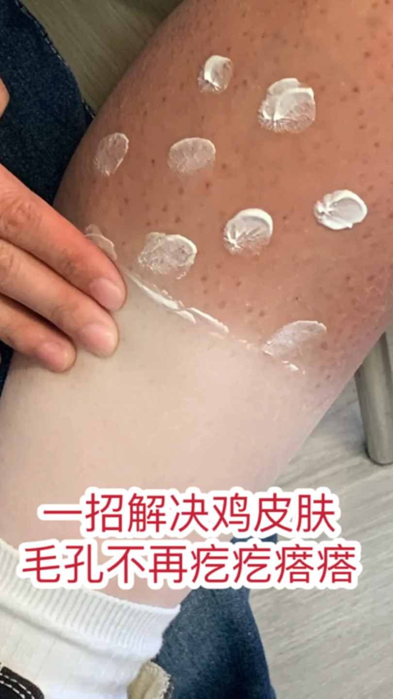 一招解决鸡皮肤,毛孔不再疙疙瘩瘩,解决鸡皮肤的小妙招