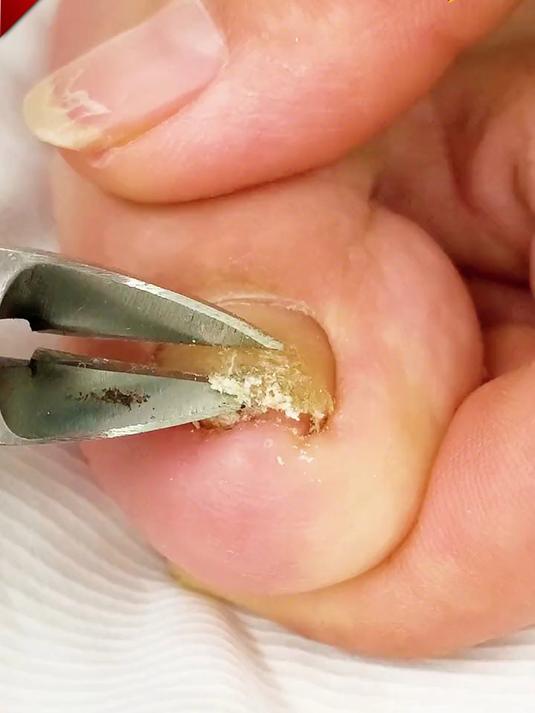 有了这个鹰嘴钳指甲刀,再也不怕脚趾甲长肉里面了,轻松处理干净