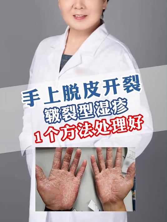 手上脱皮开裂,1个方法处理好