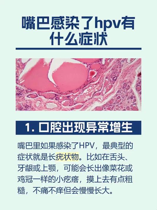 嘴巴感染了hpv有什么症状
