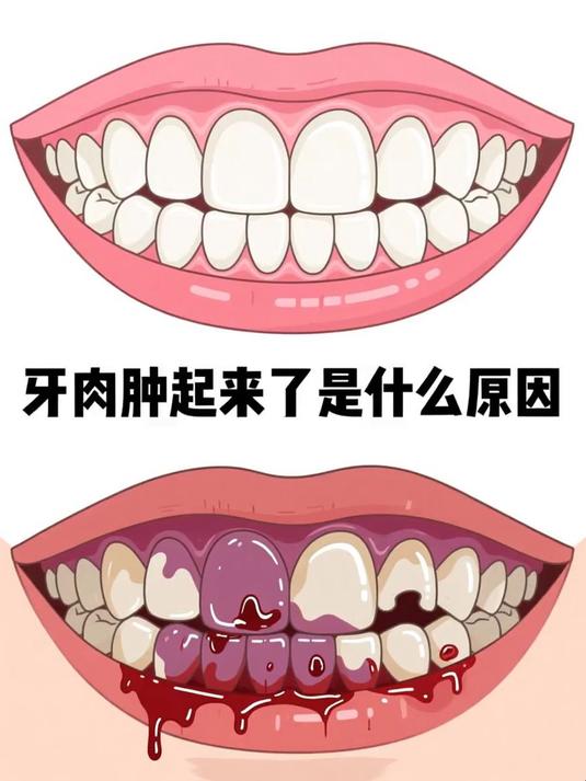 牙肉肿起来了是什么原因