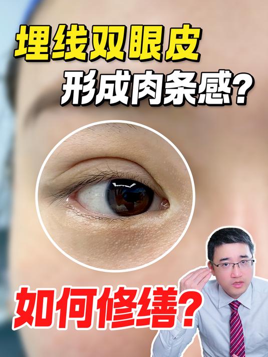 埋线双眼皮肉条感修复